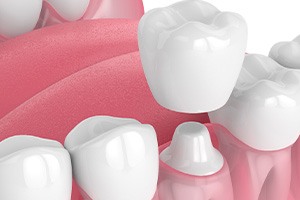 Placing a dental crown on a prepared tooth