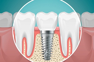 Digital illustration of a dental implant anchored to the jawbone