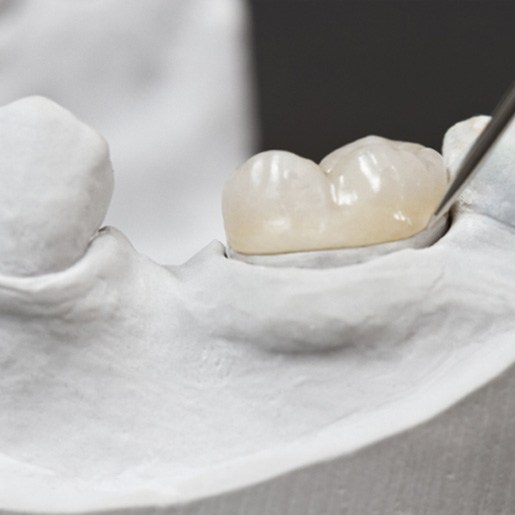 Dental crown on a model arch